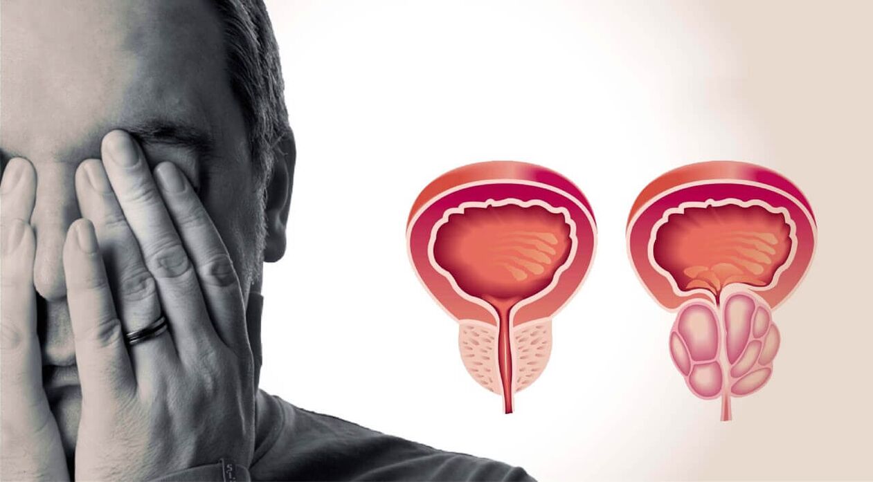 Men's health and diseased prostate