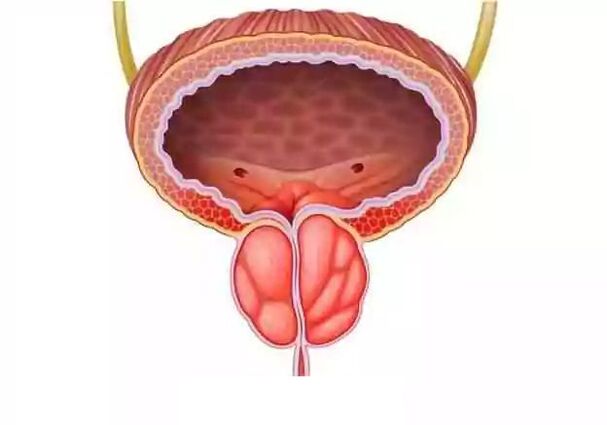 Treatment of male prostatitis