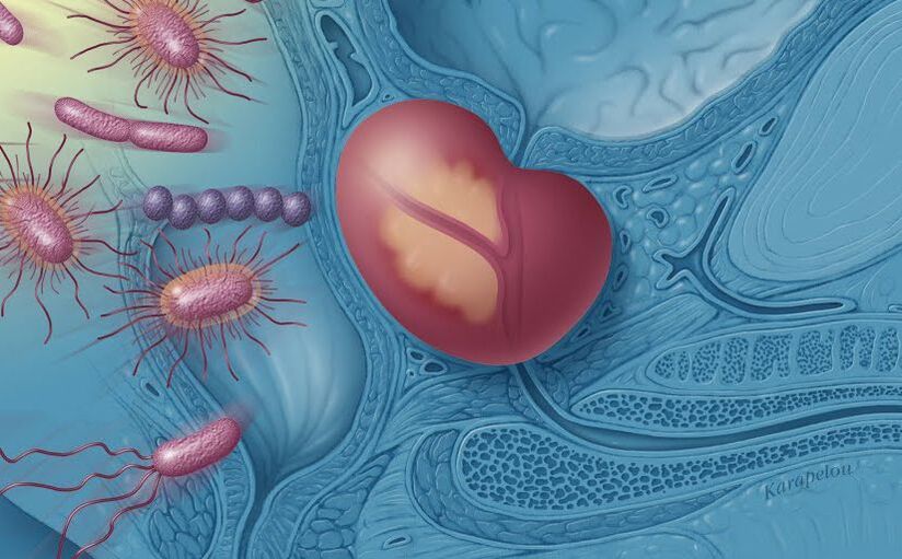 bacterial prostatitis