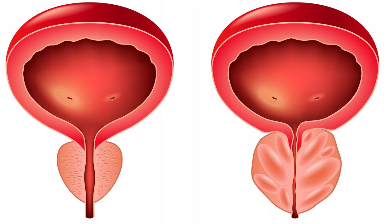 Difference Between Prostate
